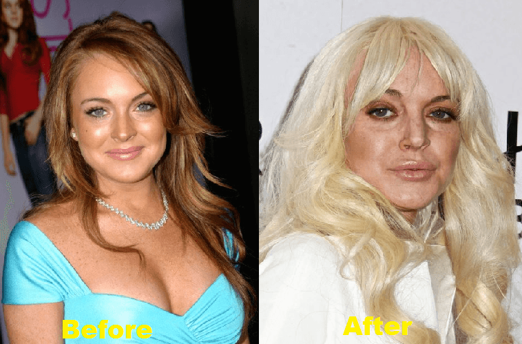 Actresses Whose Plastic Surgery Went Wrong Bollywood News And