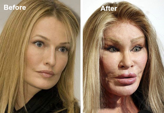 Plastic Surgery Gone Wrong Before And After Pictures